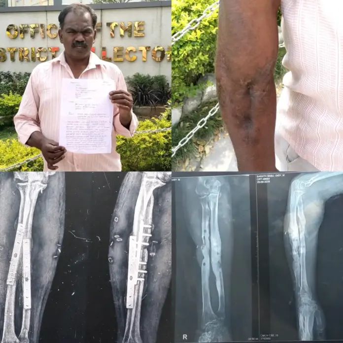 hand surgery negligence